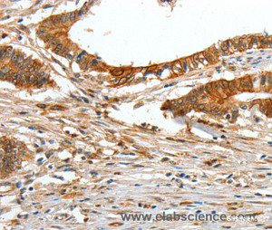 Immunohistochemistry of paraffin-embedded Human colon cancer tissue using COL1A2 Polyclonal Antibody at dilution 1:70