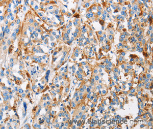 Immunohistochemistry of paraffin-embedded Human esophagus cancer tissue using Cathepsin L Polyclonal Antibody at dilution 1:50