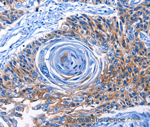 Immunohistochemistry of paraffin-embedded Human esophagus cancer tissue using CLEC2B Polyclonal Antibody at dilution 1:50