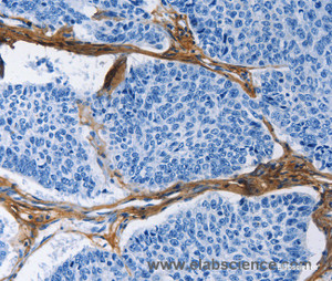 Immunohistochemistry of paraffin-embedded Human lung cancer tissue using COL3A1 Polyclonal Antibody at dilution 1:60