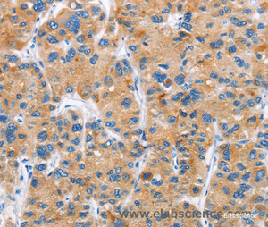 Immunohistochemistry of paraffin-embedded Human liver cancer tissue using DKK2 Polyclonal Antibody at dilution 1:60