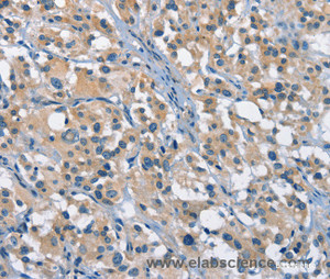 Immunohistochemistry of paraffin-embedded Human thyroid cancer tissue using GAS2 Polyclonal Antibody at dilution 1:50