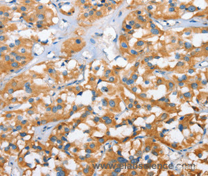 Immunohistochemistry of paraffin-embedded Human thyroid cancer tissue using CXCL14 Polyclonal Antibody at dilution 1:40