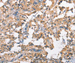 Immunohistochemistry of paraffin-embedded Human thyroid cancer tissue using SCARB1 Polyclonal Antibody at dilution 1:60