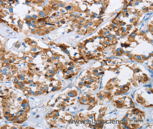 Immunohistochemistry of paraffin-embedded Human thyroid cancer tissue using HINT2 Polyclonal Antibody at dilution 1:40