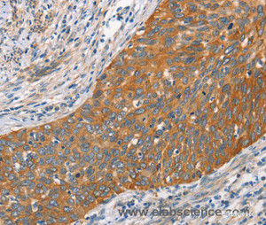 Immunohistochemistry of paraffin-embedded Human cervical cancer tissue using Crystallin-alpha C Polyclonal Antibody at dilution 1:45