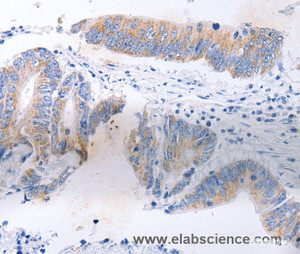 Immunohistochemistry of paraffin-embedded Human colon cancer tissue using SERP1 Polyclonal Antibody at dilution 1:30