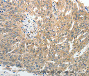 Immunohistochemistry of paraffin-embedded Human ovarian cancer tissue using E-Selectin Polyclonal Antibody at dilution of 1:40