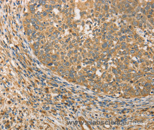 Immunohistochemistry of paraffin-embedded Human cervical cancer tissue using ATG3 Polyclonal Antibody at dilution 1:40