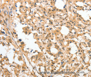 Immunohistochemistry of paraffin-embedded Human thyroid cancer tissue using APTX Polyclonal Antibody at dilution 1:50