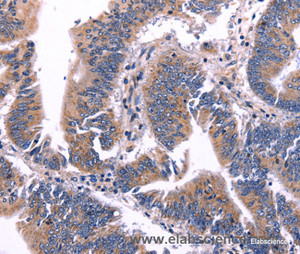 Immunohistochemistry of paraffin-embedded Human colon cancer tissue using ARC Polyclonal Antibody at dilution 1:50