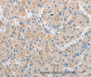 Immunohistochemistry of paraffin-embedded Human liver cancer tissue using ARHGEF9 Polyclonal Antibody at dilution 1:50