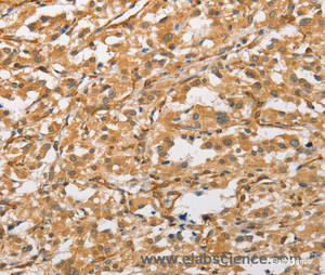 Immunohistochemistry of paraffin-embedded Human thyroid cancer tissue using ARMCX1 Polyclonal Antibody at dilution 1:40