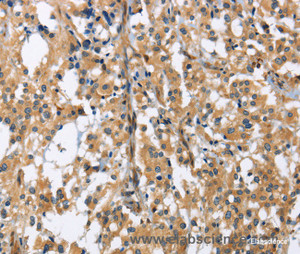 Immunohistochemistry of paraffin-embedded Human thyroid cancer tissue using GAB1 Polyclonal Antibody at dilution 1:40