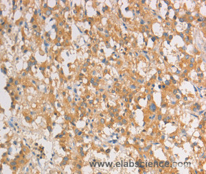 Immunohistochemistry of paraffin-embedded Human thyroid cancer tissue using ART3 Polyclonal Antibody at dilution 1:40