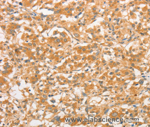 Immunohistochemistry of paraffin-embedded Human thyroid cancer tissue using TLR3 Polyclonal Antibody at dilution 1:50