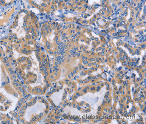 Immunohistochemistry of paraffin-embedded Human thyroid cancer tissue using DOK4 Polyclonal Antibody at dilution 1:50