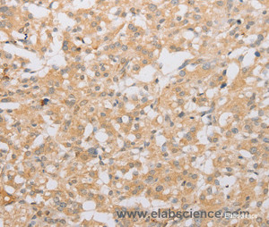 Immunohistochemistry of paraffin-embedded Human thyroid cancer tissue using ATG9A Polyclonal Antibody at dilution 1:40