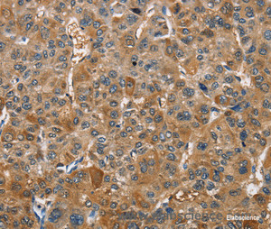 Immunohistochemistry of paraffin-embedded Human liver cancer tissue using TRIP4 Polyclonal Antibody at dilution 1:40