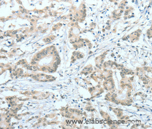Immunohistochemistry of paraffin-embedded Human colon cancer tissue using ASH2L Polyclonal Antibody at dilution 1:60
