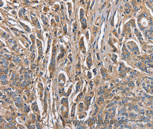 Immunohistochemistry of paraffin-embedded Human prostate cancer tissue using ABI3BP Polyclonal Antibody at dilution 1:60