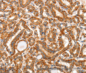 Immunohistochemistry of paraffin-embedded Human thyroid cancer tissue using AIM2 Polyclonal Antibody at dilution 1:60