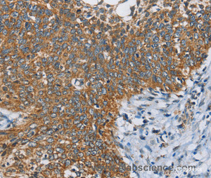 Immunohistochemistry of paraffin-embedded Human cervical cancer tissue using ANKHD1 Polyclonal Antibody at dilution 1:40