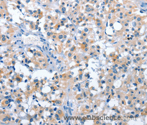 Immunohistochemistry of paraffin-embedded Human thyroid cancer tissue using ASB2 Polyclonal Antibody at dilution 1:50