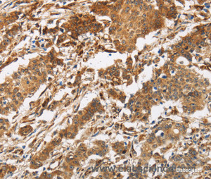 Immunohistochemistry of paraffin-embedded Human gasrtic cancer tissue using CALU Polyclonal Antibody at dilution 1:40