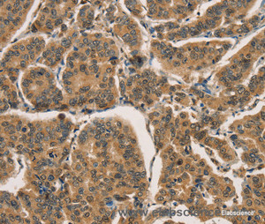 Immunohistochemistry of paraffin-embedded Human breast cancer tissue using CTNNBIP1 Polyclonal Antibody at dilution 1:30