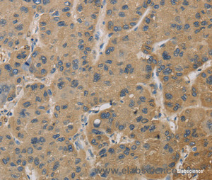 Immunohistochemistry of paraffin-embedded Human liver cancer tissue using TBXAS1 Polyclonal Antibody at dilution 1:30