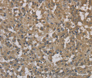 Immunohistochemistry of paraffin-embedded Human thyroid cancer tissue using DCTN3 Polyclonal Antibody at dilution 1:70