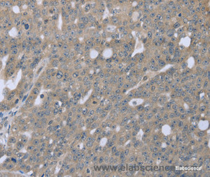 Immunohistochemistry of paraffin-embedded Human ovarian cancer tissue using BMX Polyclonal Antibody at dilution 1:30