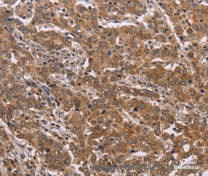 Immunohistochemistry of paraffin-embedded Human liver cancer tissue using FAAH2 Polyclonal Antibody at dilution 1:30