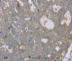 Immunohistochemistry of paraffin-embedded Human ovarian cancer tissue using FAR2 Polyclonal Antibody at dilution 1:40