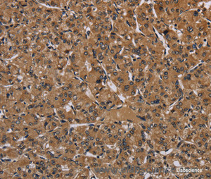 Immunohistochemistry of paraffin-embedded Human prostate cancer tissue using HIF1 alpha Polyclonal Antibody at dilution 1:60