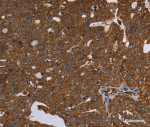 Immunohistochemistry of paraffin-embedded Human ovarian cancer tissue using HSD17B13 Polyclonal Antibody at dilution 1:30