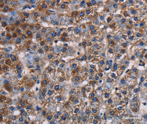 Immunohistochemistry of paraffin-embedded Human lung cancer tissue using KCNK1 Polyclonal Antibody at dilution 1:50