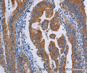 Immunohistochemistry of paraffin-embedded Human gasrtic cancer tissue using ACP6 Polyclonal Antibody at dilution 1:50