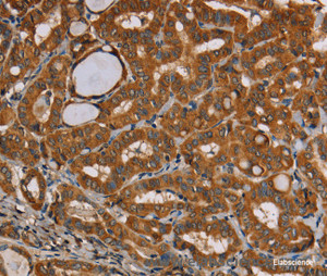 Immunohistochemistry of paraffin-embedded Human thyroid cancer tissue using CENPU Polyclonal Antibody at dilution 1:30