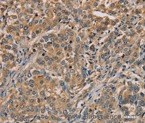 Immunohistochemistry of paraffin-embedded Human liver cancer tissue using NANOS2 Polyclonal Antibody at dilution 1:30