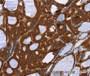 Immunohistochemistry of paraffin-embedded Human thyroid cancer tissue using PPP2R3C Polyclonal Antibody at dilution 1:30