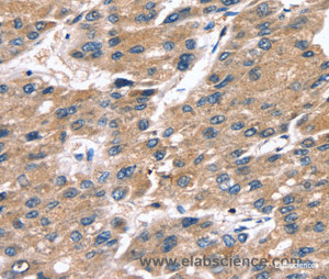 Immunohistochemistry of paraffin-embedded Human liver cancer tissue using SRGN Polyclonal Antibody at dilution 1:25