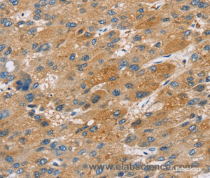 Immunohistochemistry of paraffin-embedded Human liver cancer tissue using ST18 Polyclonal Antibody at dilution 1:50