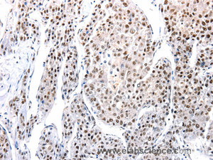 Immunohistochemistry of paraffin-embedded Human liver cancer tissue using AQP2 Polyclonal Antibody at dilution 1:100