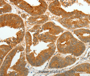 Immunohistochemistry of paraffin-embedded Human colon cancer tissue using ASCL1 Polyclonal Antibody at dilution 1:30