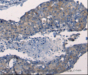 Immunohistochemistry of paraffin-embedded Human breast cancer tissue using FGF2 Polyclonal Antibody at dilution 1:50