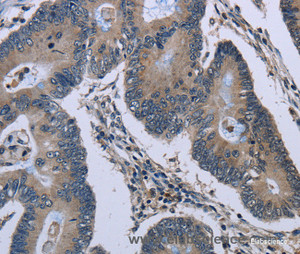 Immunohistochemistry of paraffin-embedded Human colon cancer tissue using Connexin 47 Polyclonal Antibody at dilution 1:40