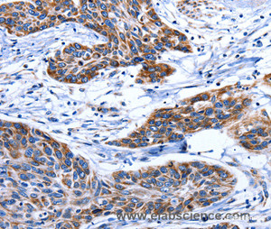 Immunohistochemistry of paraffin-embedded Human esophagus cancer tissue using AQP8 Polyclonal Antibody at dilution 1:75