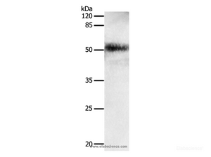 Western Blot analysis of Human lung cancer tissue using EDA Polyclonal Antibody at dilution of 1:650